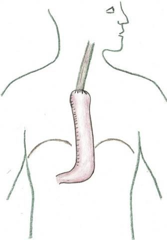 Speiseröhrenchirurgie_Rekonstruktion Magenschlauch